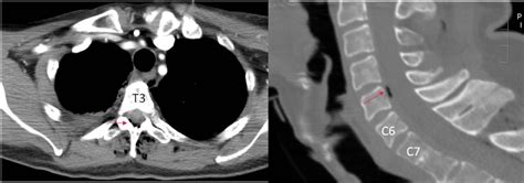 Axial Ct Of The Upper Thoracic Spine And Sagittal Reconstruction Of The