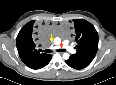 Superior Vena Cava Syndrome And Telangiectasia In A Man With Lymphoma