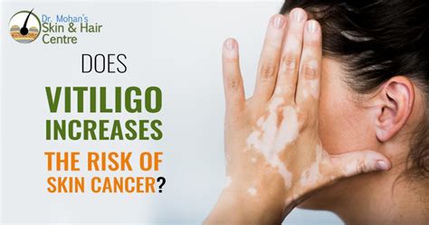 Does Vitiligo Increases The Risk Of Skin Cancer