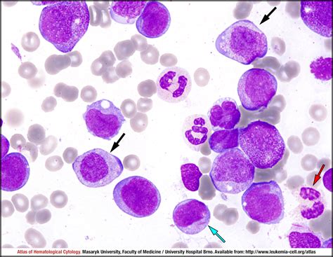 Acute Myeloid Leukaemia With T821q22q22 Runx Runx1t1 Cell