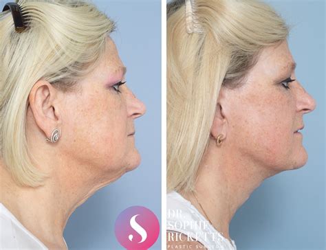 Face Lift Neck Lift Melbourne Plastic Surgery Procedure Dr Sophie