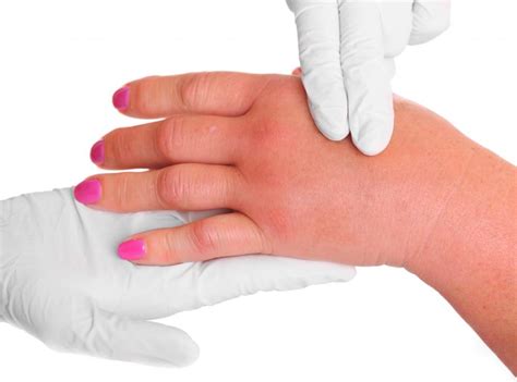 What Is Hand Cellulitis With Pictures