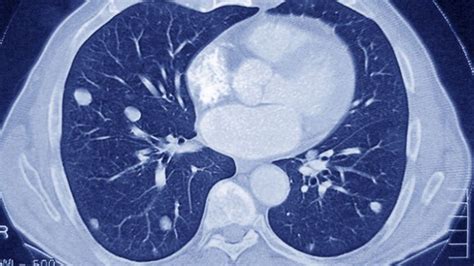 Câncer de pulmão conheça sintomas fatores de risco diagnóstico e