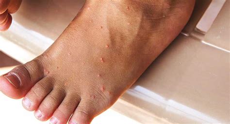 Cellulitis Causes Symptoms Treatments And Pictures