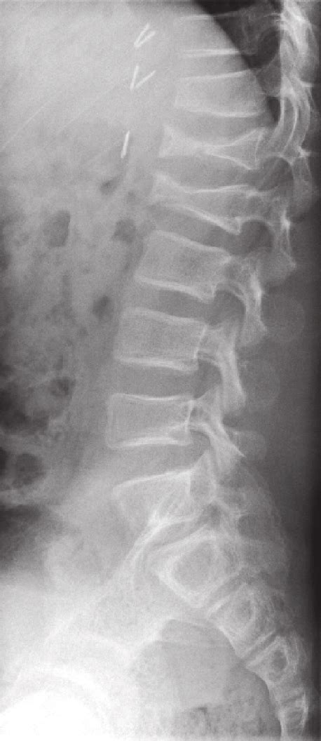 Infection, malalignment of bones or loosening, migration or failure of orthopaedic implants like joint. Patient 2. X-Ray of the lumbar spine showing severe loss ...