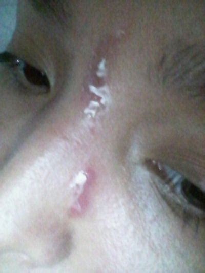 Considering that babies heal faster than adults, the scratch should be noticeably clearing within days. What should I do about these scratches on my face? (Photo ...