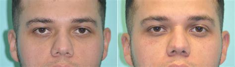 Injections Tear Trough Under Eye Injections Photos Chevy Chase Md