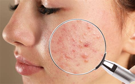 How To Treat Your Blind Pimples With Ayurveda Vedix