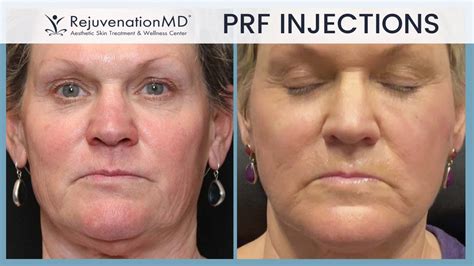 PRF Under Eye Injections YouTube