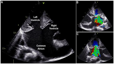 Echocardiogram Shows A Common Atrium With A Large Atrioseptal Defect