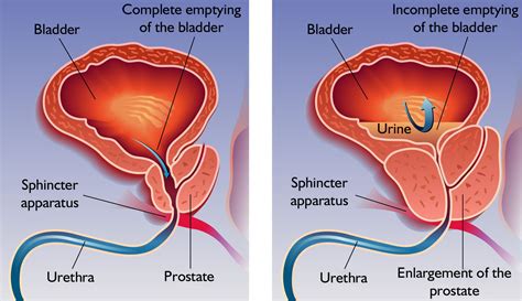 Symptoms And Treatment Of Prostate Enlargement Mysurgeryabroad Medicover Hospital Hospital