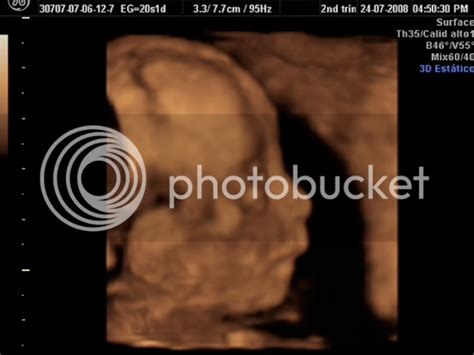 Adbanasa 3d Ultrasound 20 Weeks Boy