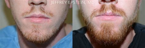 Beard hair transplantation is a procedure which restores hair to areas where facial hair growth is thin or missing. Facial Hair Transplant | Beard Trasplant | Miami, FL | New ...