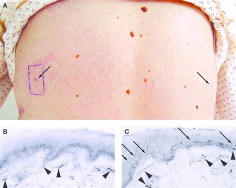 Skin Biopsy In Notalgia Paresthetica A Biopsies Were Performed