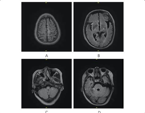 Brain Mri Findings Of Patient No3 The Brain Mri Was Obtained 10