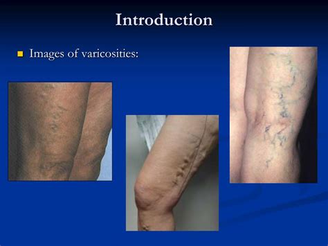 Ppt Varicose Veins More Than Just A Cosmetic Problem Powerpoint