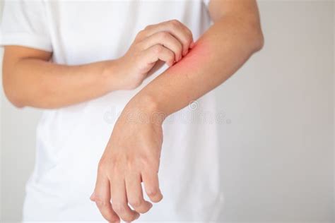 Man Itching And Scratching On Arm From Itchy Dry Skin Eczema Dermatitis