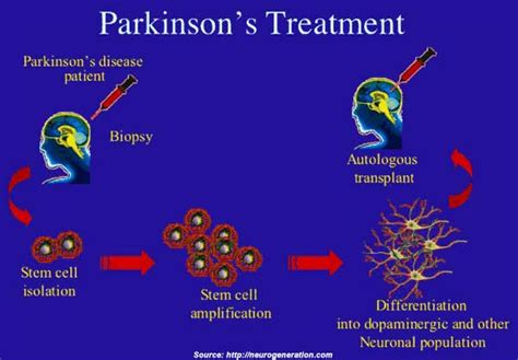 Parkinsons Disease Types Symptoms Causes Diagnosis And Treatment