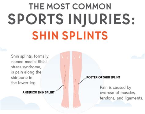 Shin Splints Typescauses Symptomstreatment And Prevention How To