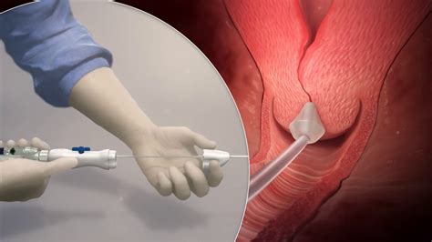 Definity Cervical Dilator Product Animation Youtube