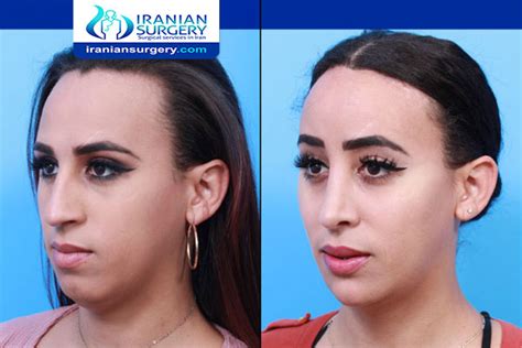 Facial Feminization Surgery Cost Iran Ffs Surgery