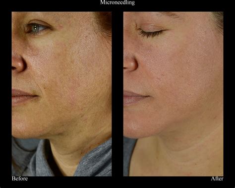 A Complete Guide To Microneedling Including Before An