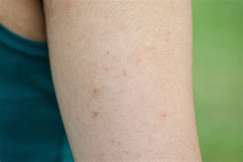 Ever Wonder Why You Get Those Weird Little Red Bumps On Your Arms