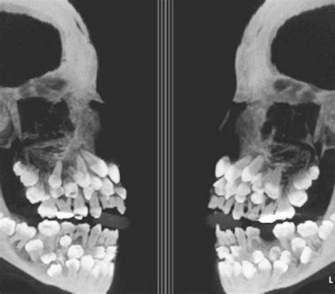 X Ray Of Babys Skull Roddlyterrifying