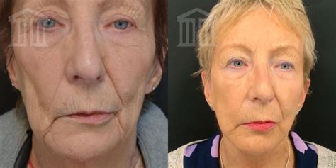 Facelift Surgery Zenith Cosmetic Clinics