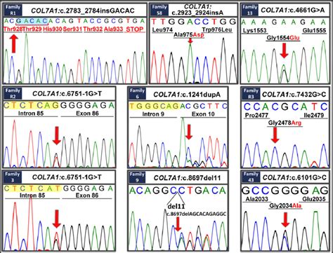 Examples Of Sanger Sequencing Traces Depicting Mutations In Col7a1 Download Scientific Diagram