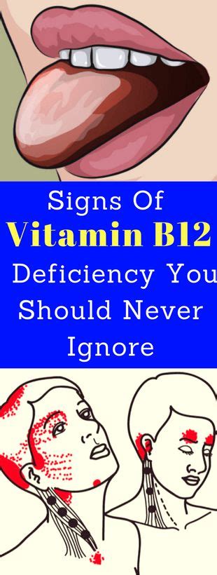 Signs Of Vitamin B12 Deficiency You Should Never Ignore Healthymasters