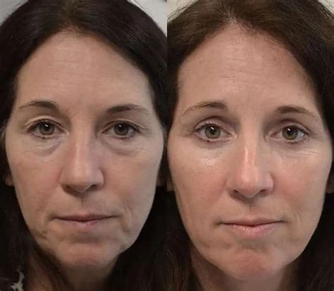Eyelid Surgery Before And After Photos Blepharoplasties In Chatham Nj
