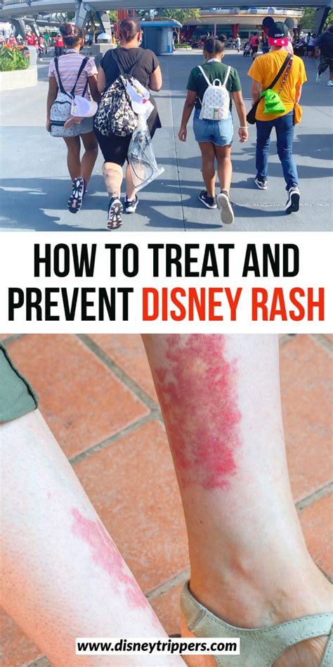 How To Treat And Prevent Disney Rash Disney Trippers Disney Rash