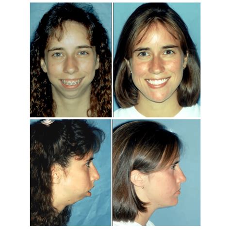 Before And After Photos Maxillofacial Surgery Larry M Wolford Dmd