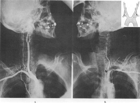 Surgical Management Of Varying Patterns Of Vertebral Artery And