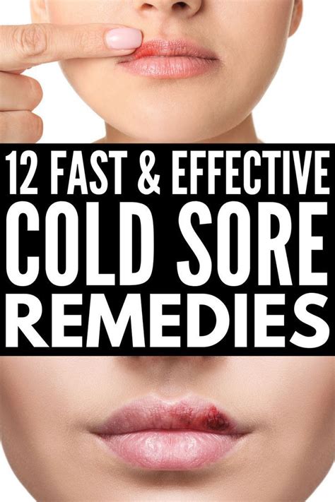 Fast And Effective 12 Natural Cold Sore Remedies That Work In 2020