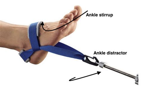 This Image Details The Setup For An Ankle Arthroscopy The Ankle Is