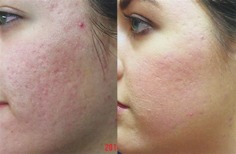 Is Co2 Laser Effective For Acne Scars