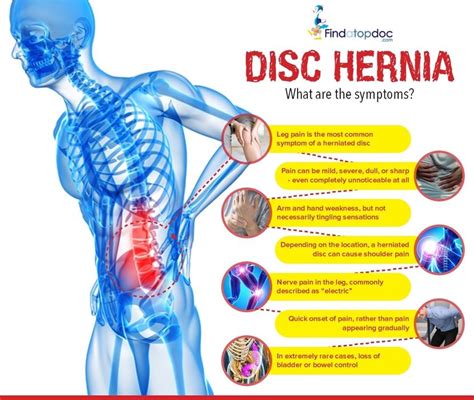 Herniated Disc Symptoms Causes Treatment And Diagnosis Findatopdoc