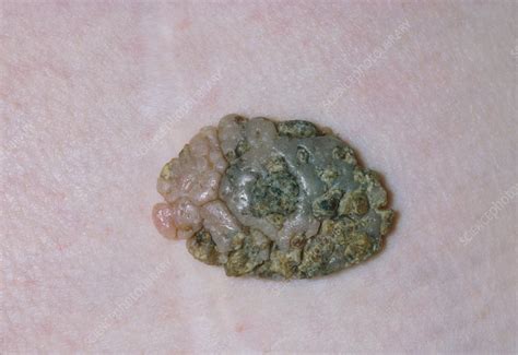 Close Up Of A Seborrhoeic Keratosis Or Wart Stock Image M1900032