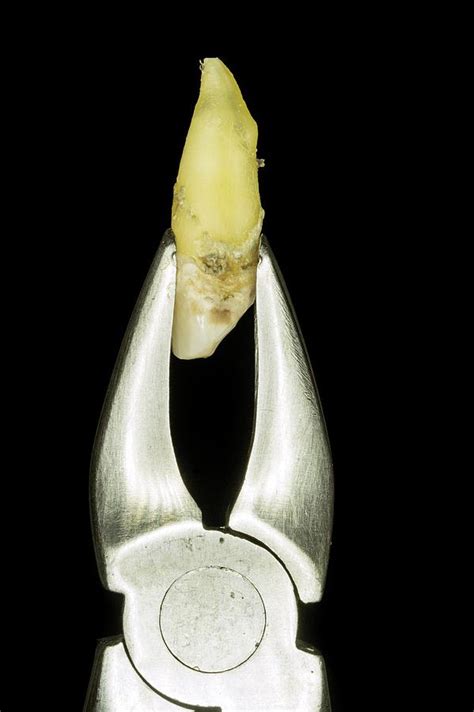 Extracted Upper Incisor Tooth Photograph By Dr Armen Taranyan Science