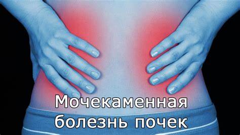 Диета мочекаменная болезнь почек Мочекаменная болезнь почек: симптомы, причины - YouTube Мочекаменная болезнь почек: симптомы, причины - YouTube Диета мочекаменная болезнь почек