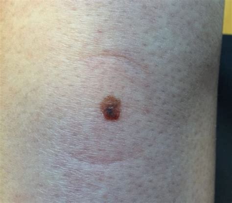 Freckle Spotted By Husband On Womans Leg Turns Out To Be Cancer Metro News