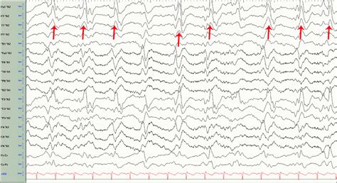 Epileptiform Abnormalities Springerlink