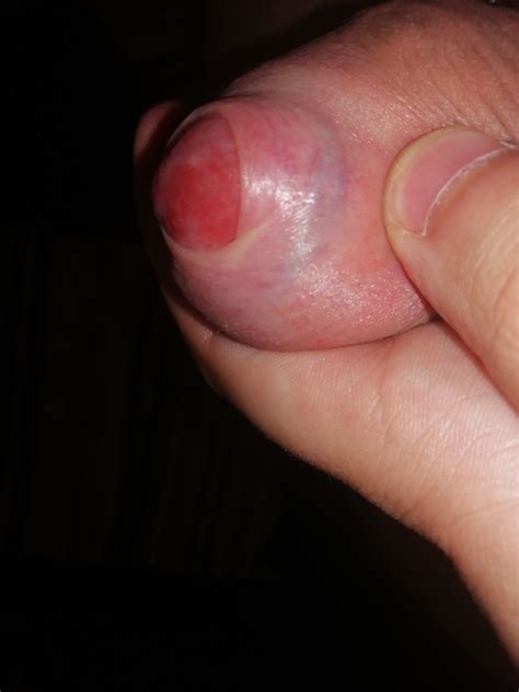 Red Gland On Left Side Of Penis Penis Disorders Forums Patient