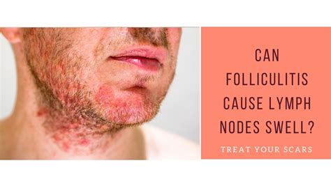Can Folliculitis Cause Lymph Nodes Swell Treat Your Scars