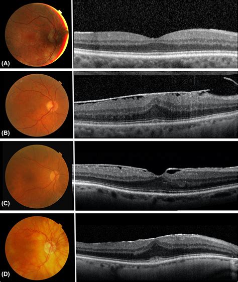 Prevalence Of Epiretinal Membranes In The Ageing Population Using
