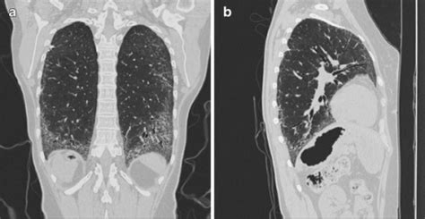 Coronal And Sagittal Chest Ct Reconstructions Lung Win Open I