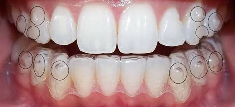 Ortodoncia Con Invisalign Dentisalut