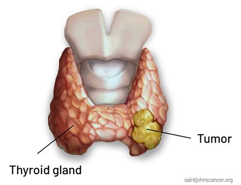 thyroid cancer symptoms diagnosis surgery treatment and prognosis saint john s cancer